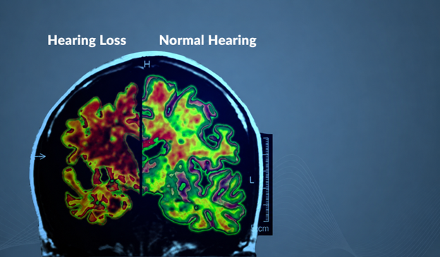 Picture1 Brain MRI cross-section showing left side labeled Hearing Loss and right side labeled Normal Hearing with a colorful activity map on a blue background.